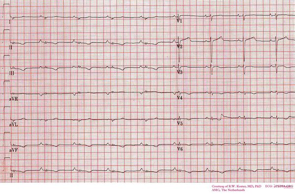 Microvoltations - ECGpedia