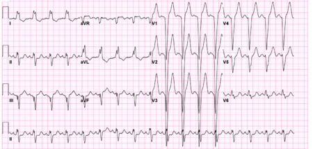 Intraventricular Conduction - ECGpedia