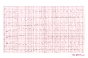 Brugada syndrome type1 example6.jpg
