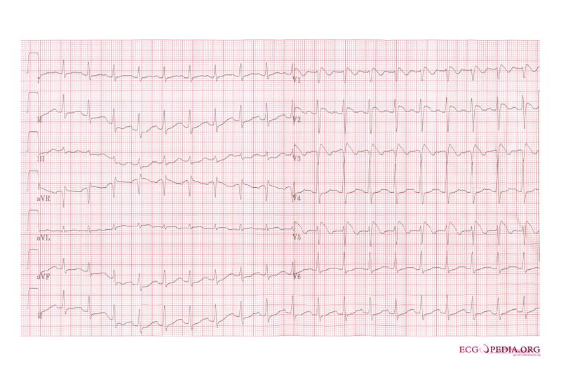 Bestand:Brugada syndrome type1 example6.jpg