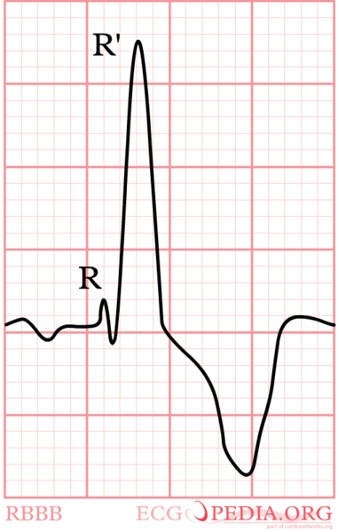 Bestand:RBBB.png