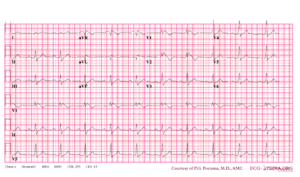 Brugada syndrome type1 example3.png