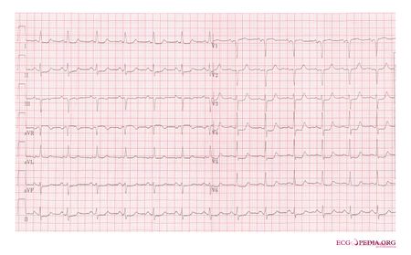 Myocardial Infarction - ECGpedia