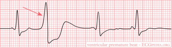 Ventricular Premature Beats - ECGpedia