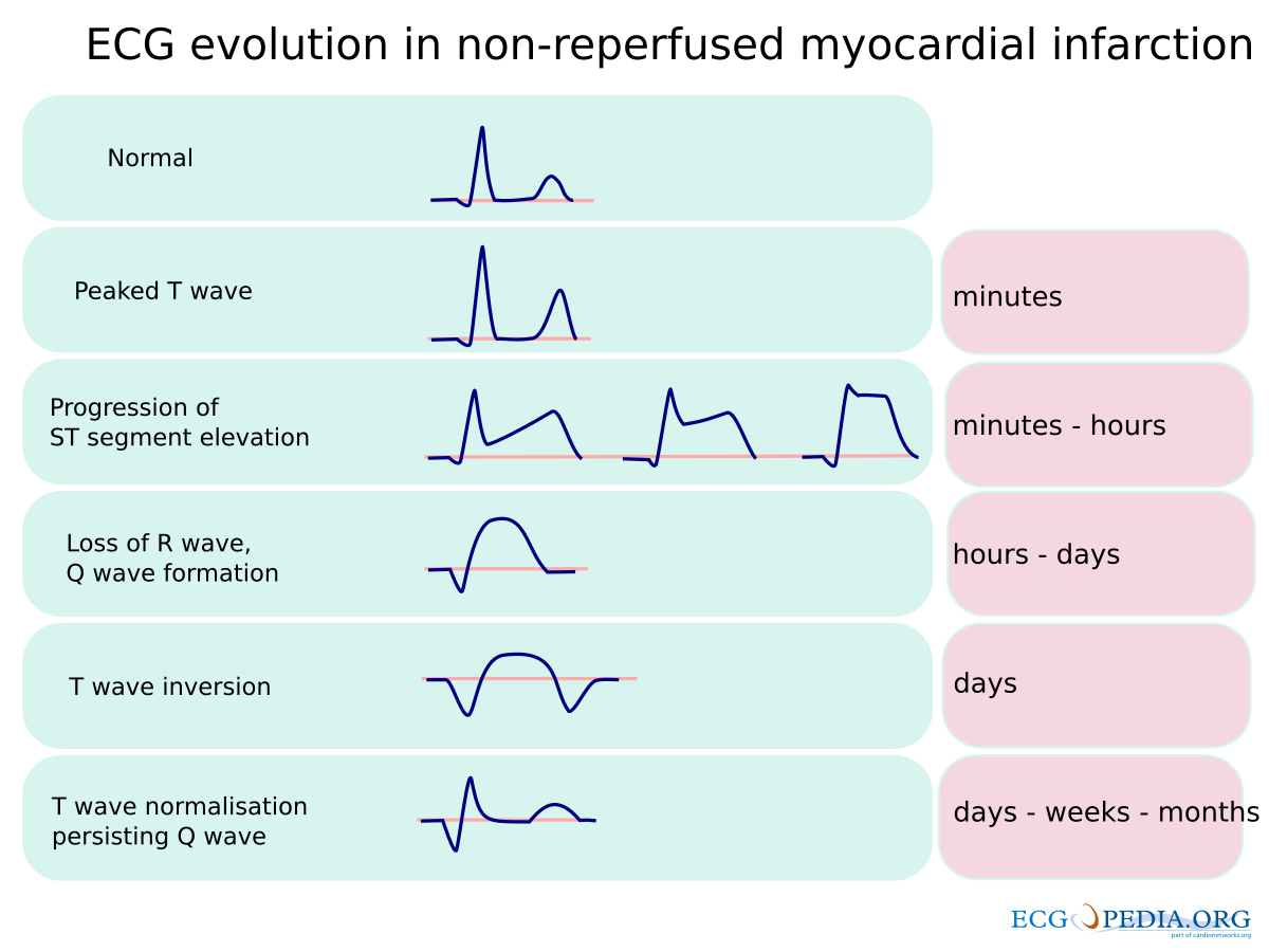 bestand-mi-evolution-svg-ecgpedia