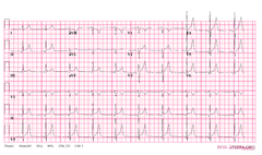 Pericarditis - ECGpedia