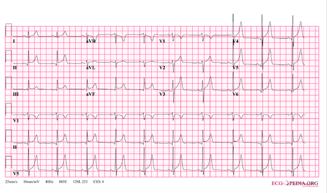 File:12leadpericarditis.png - ECGpedia