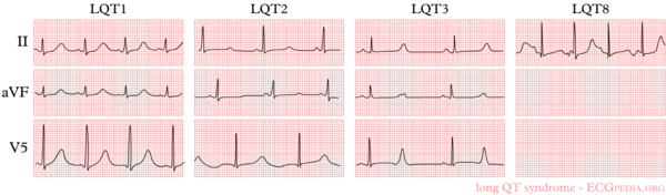 Long QT Syndrome ECGpedia