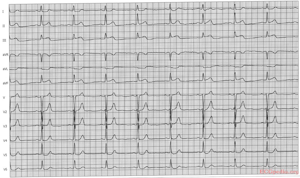 MI 11 - ECGpedia