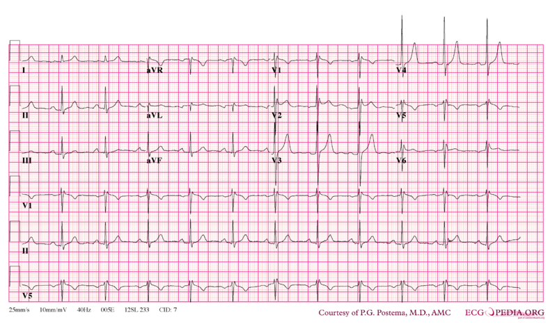 Bestand:Brugada syndrome type2 example1.png