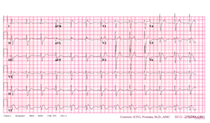 Brugada syndrome type1 example1.png