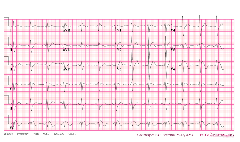Bestand:Brugada syndrome type1 example1.png
