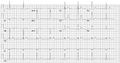 Another example of pre-exitation on a 12 lead ECG