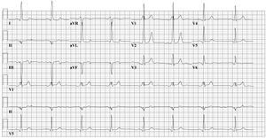 Wpw full ecg2.jpg